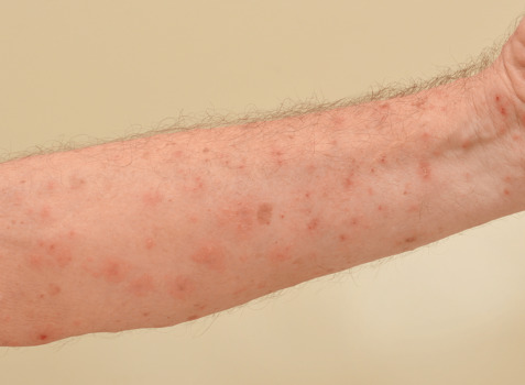 An arm severely infested with Scabies