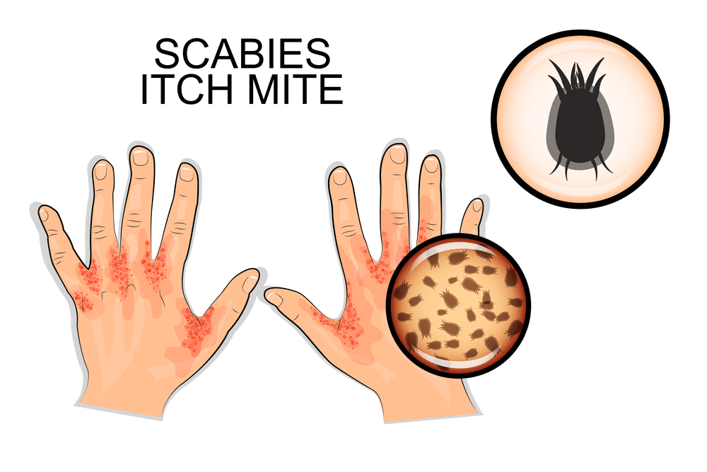 Read more about the article Scabies rash treatment Causes & symptoms