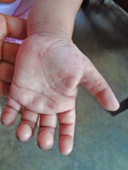 scabies in children, hand of a child with scabies