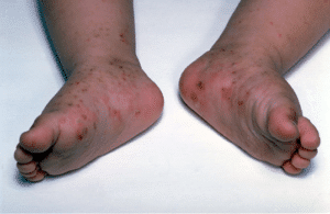 Read more about the article what does scabies look like