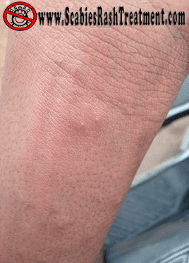 scabies rash on the forearm