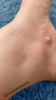 Scabies on the ankles picture