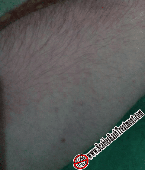 pic of scabies on arm