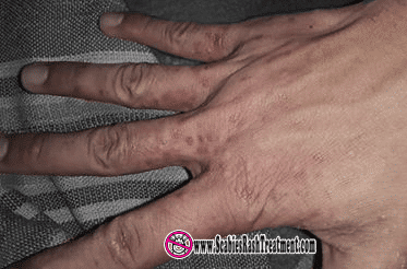 scabies on hands