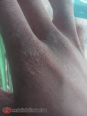 photos of scabies between fingers