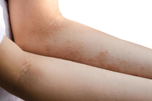 Red bumps on forearm skin